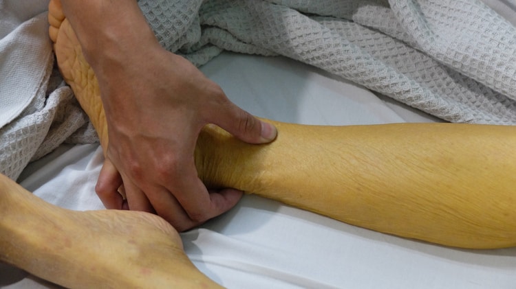 Vàng da tắc mật - Hình ảnh minh họa